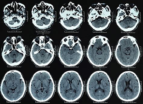 the villages brain ct scan|CT Scan .